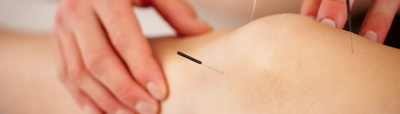 Dry Needling at Feel Amazing Wellness Centre, Chatswood